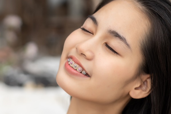 Types Of Braces For Teeth Straightening